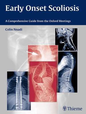 cover image of Early Onset Scoliosis